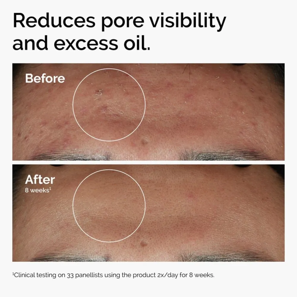 Niacinamide 10% + Zinc 1% 30 ml. Serum>The Ordinary Discount